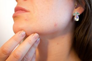 Best acne scar removal creams