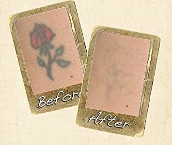 Best tattoo removal creams