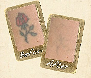 Best tattoo removal creams